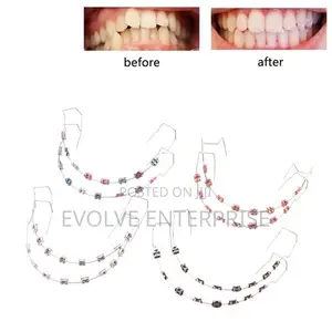 1pair Colorful Temporary Tooth Braces With Metal Wires