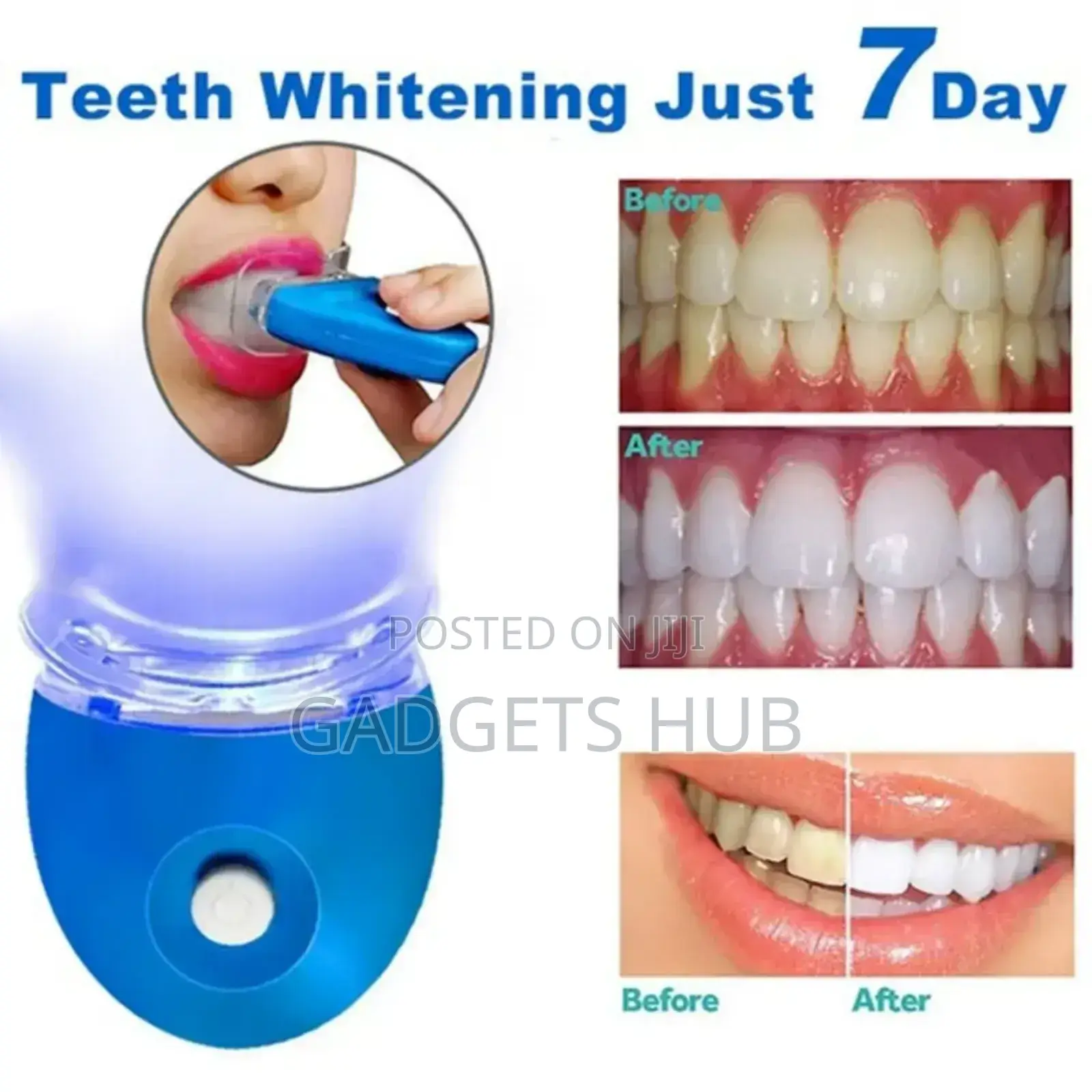 Blue Light Teeth Whitening Kit 7-Day for Sensitive Teeth,