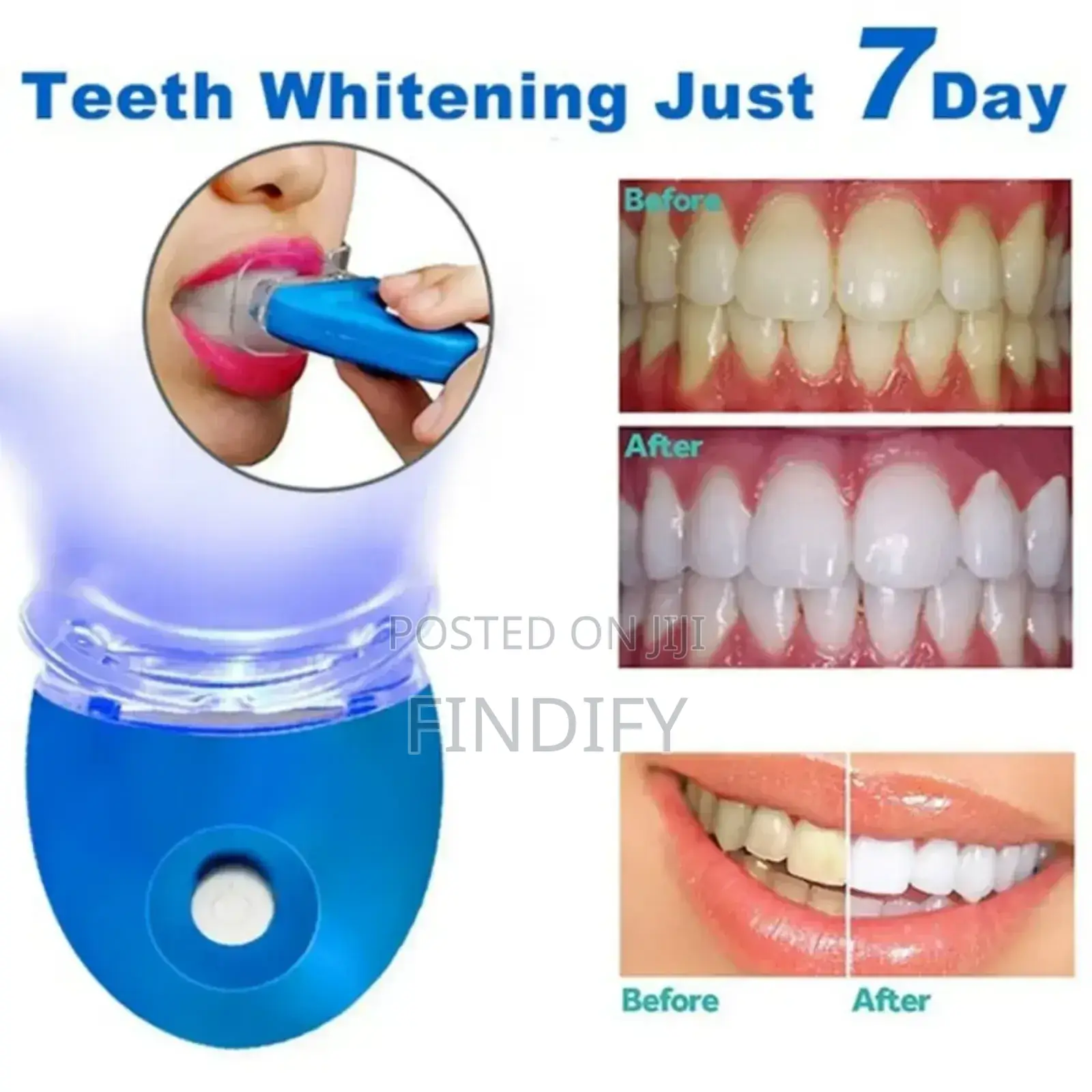 Blue Light Teeth Whitening Kit 7-Day for Sensitive Teeth,