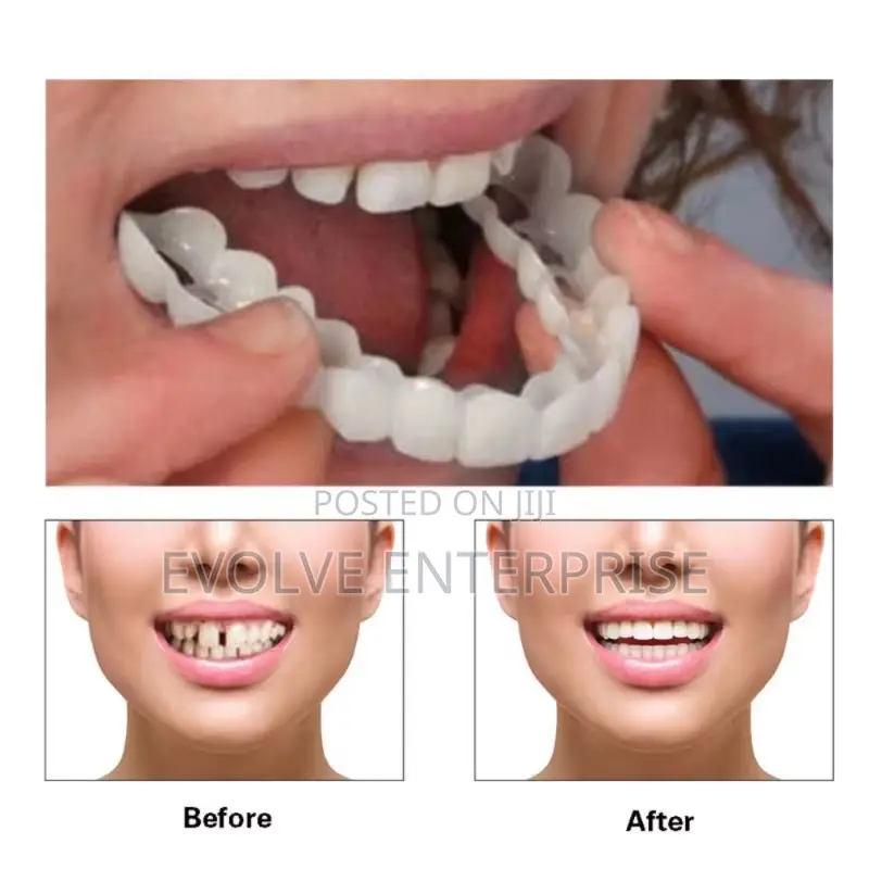 Denture Cover Veneer Snap-on Teeth Kit Fake Temporary Tooth