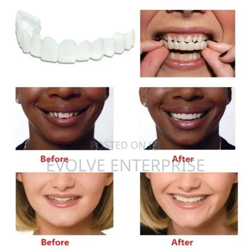 Denture Cover Veneer Snap-on Teeth Kit Fake Temporary Tooth