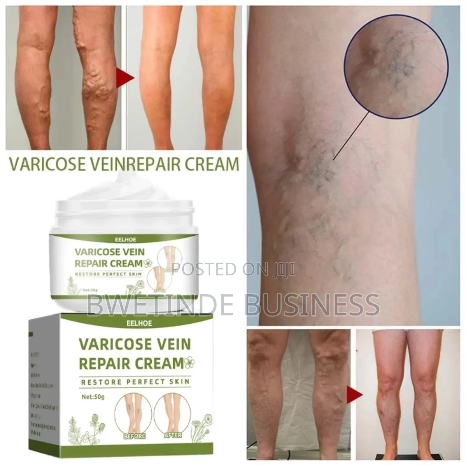 Varicose Veins Cream, Spider Veins Repair Cream