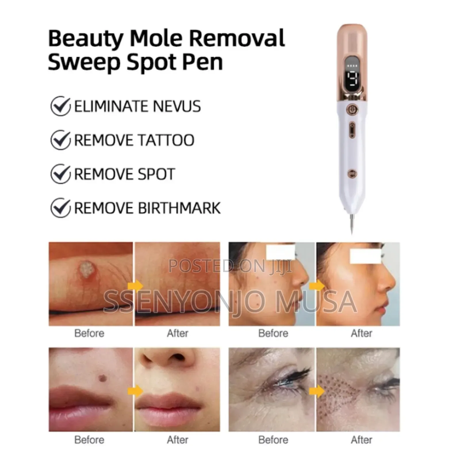 Skin Tag Remover Kit - Effective Mole Wart Removal