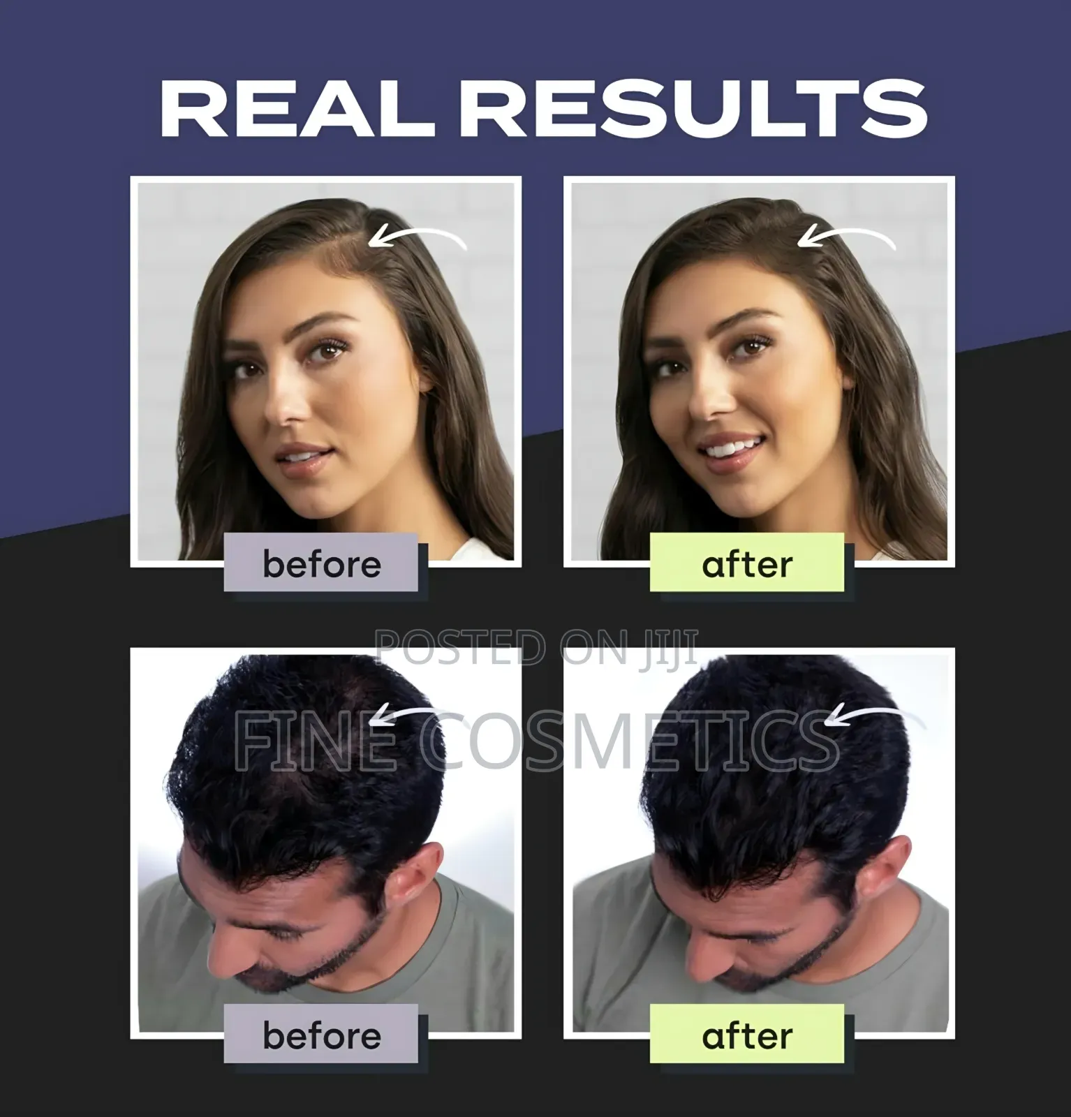Toppik Hair Building Perfecting Kit for Hair Loss + Thinning