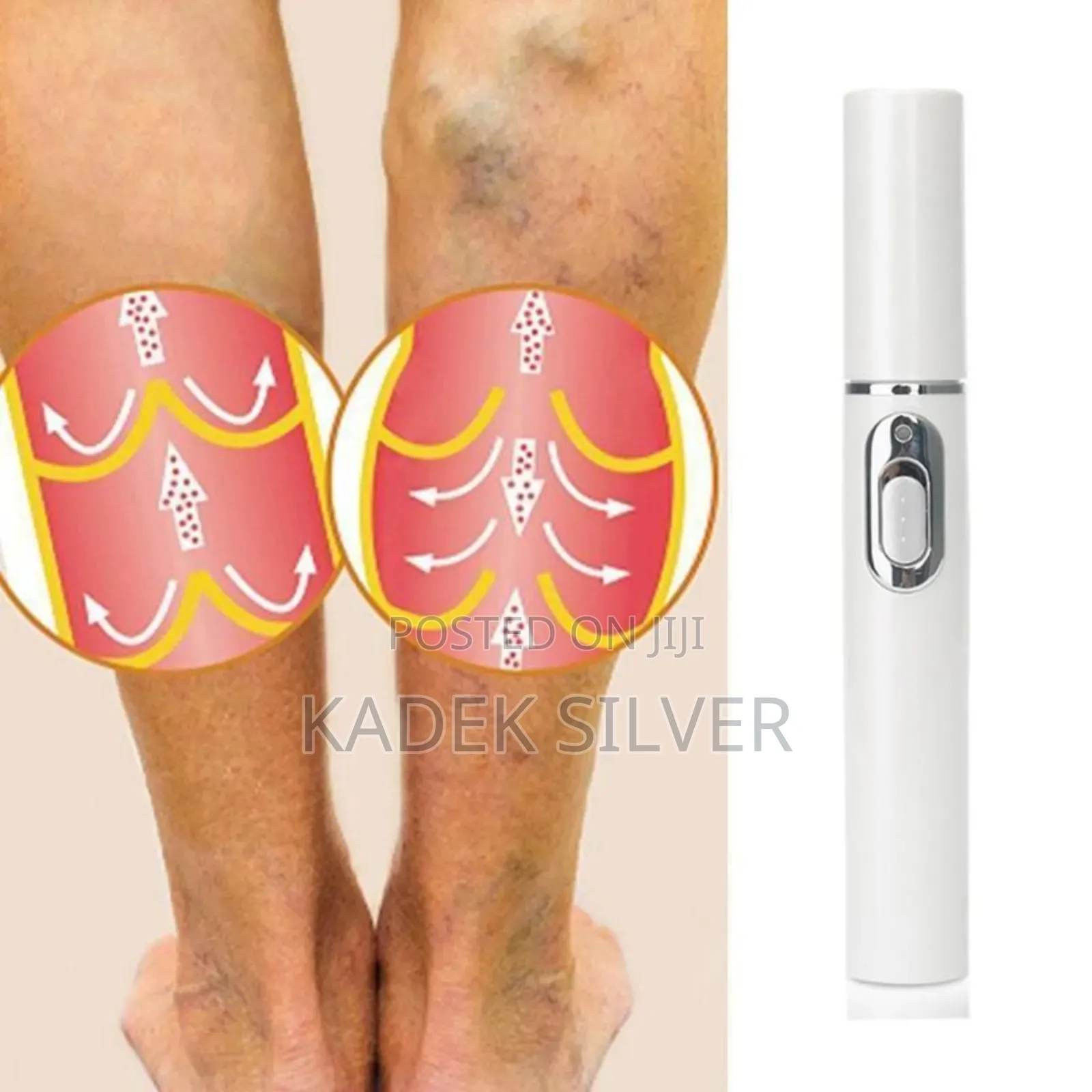 Vericose Treatment Pen 1