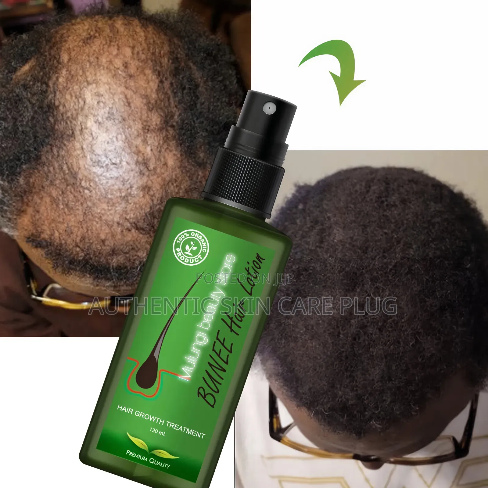 Bunee Hair Growth Treatment 100% Organic Product With Premium Quality.