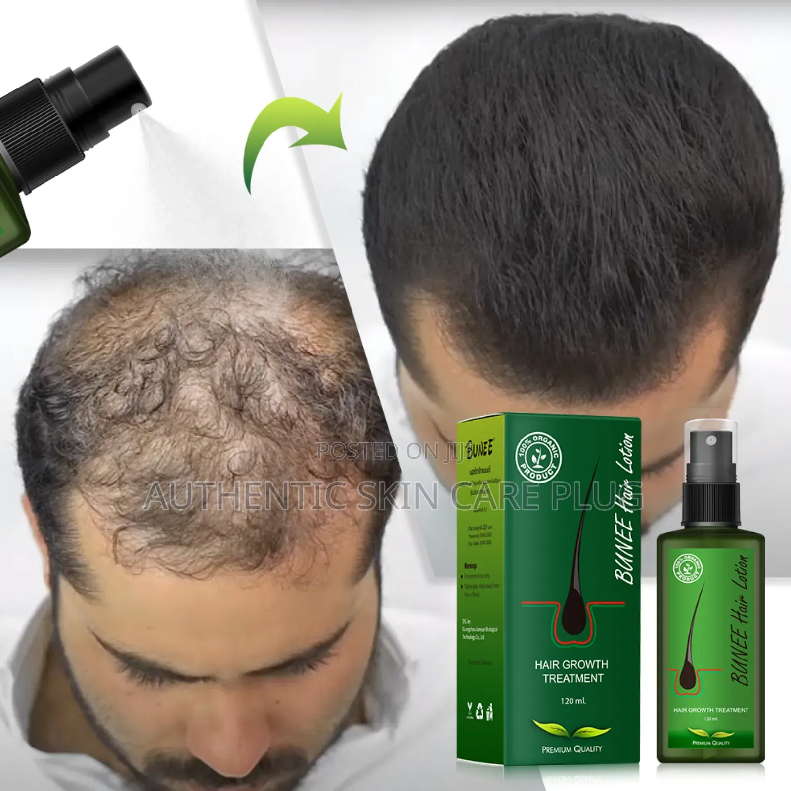 Bunee Hair Growth Treatment 100% Organic Product With Premium Quality.