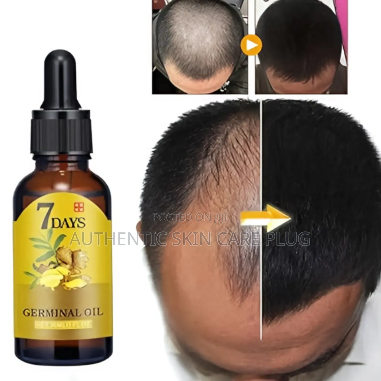 7 Days Fast Ginger Hair Growth Serum Anti-Loss Hair Regrowth