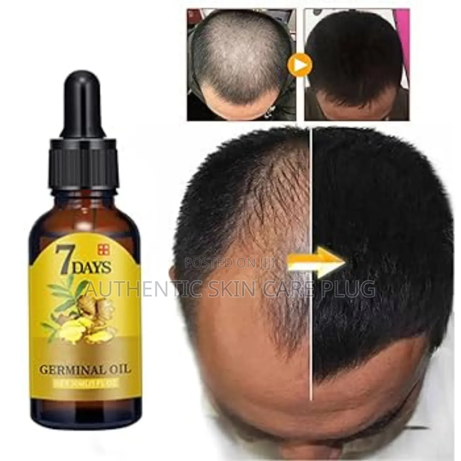 7 Days Fast Ginger Hair Growth Serum Anti-Loss Hair Regrowth
