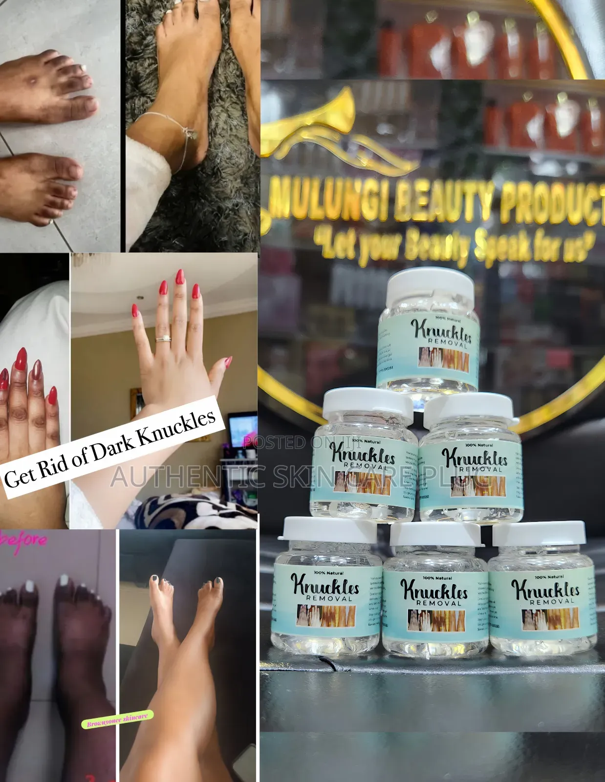 7days Knuckles Removal Gel, Hands Feet ,Knee,Etc