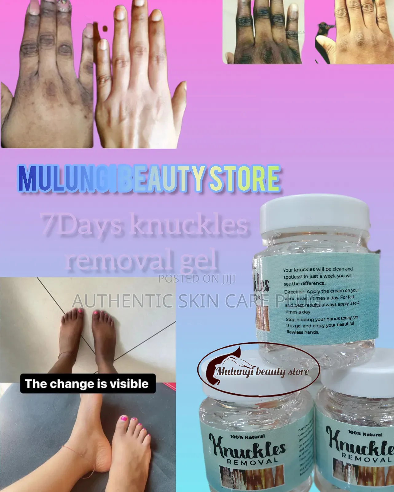 7days Knuckles Removal Gel, Hands Feet ,Knee,Etc