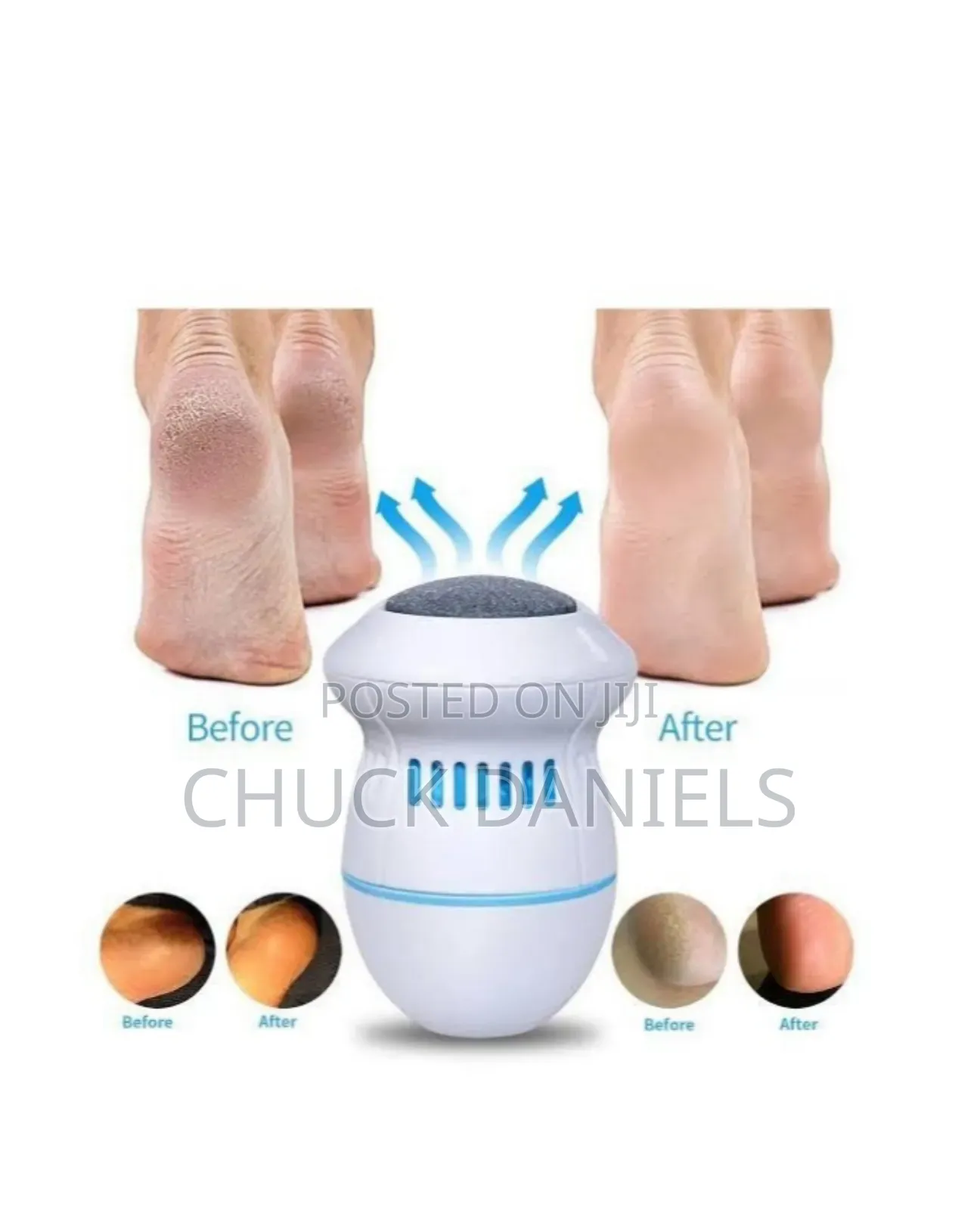 Callus Remover for Pedicure