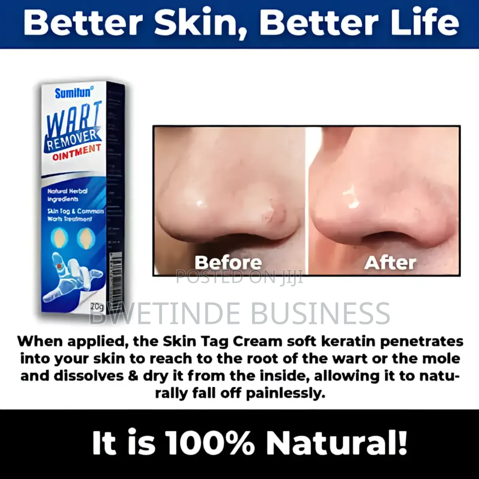 Wart Removal Cream