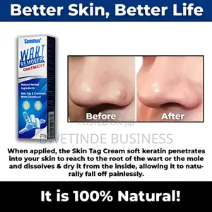 Wart Removal Cream