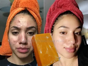 Skin Treatment Soap