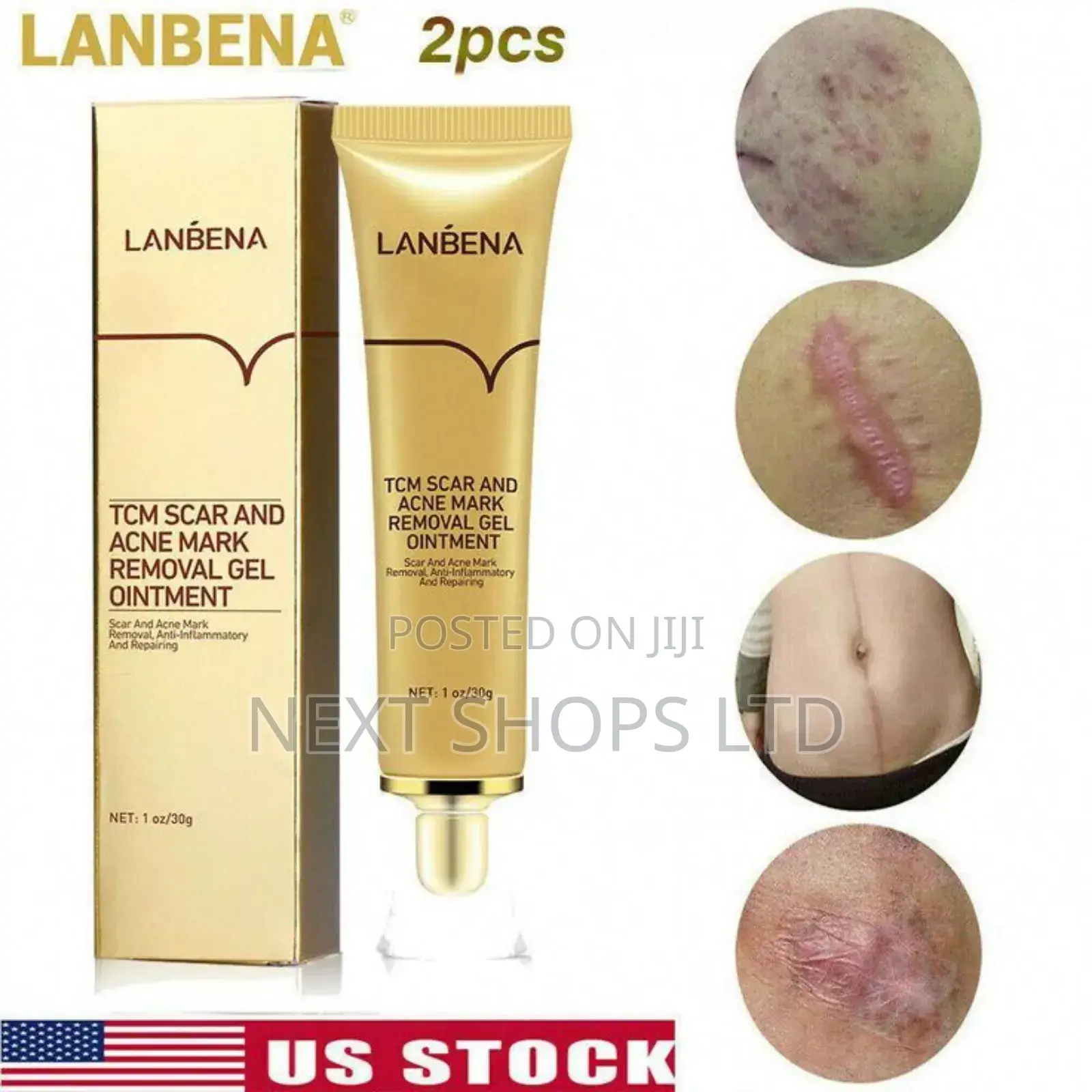 Scar Remover Cream/Scar Removal/Acne Treatment/Scars Removals Cream