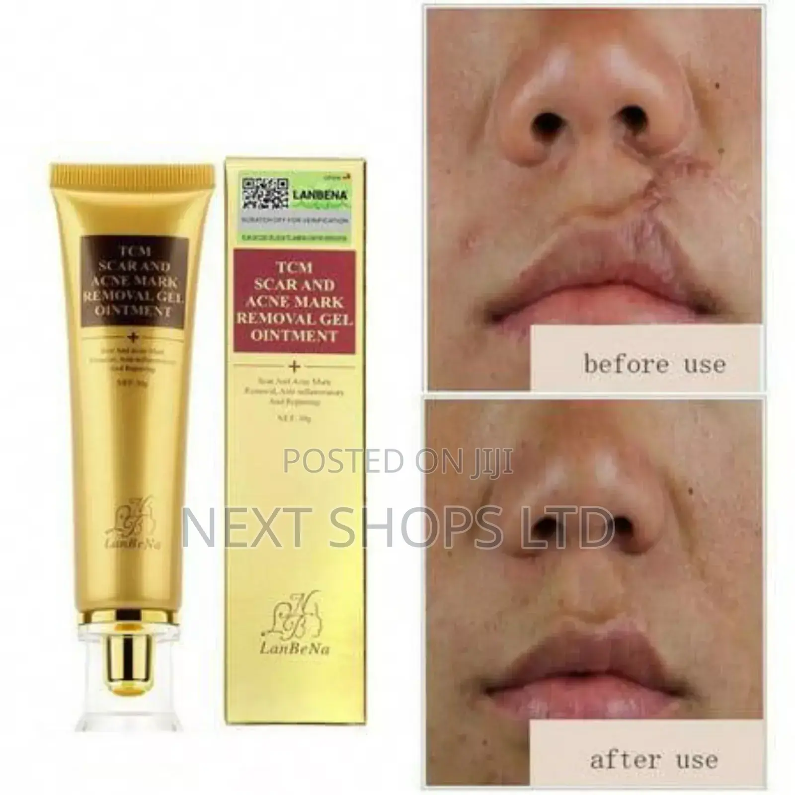Original Scar Removal Cream/Scar Removal Ointment/Acne Treatment