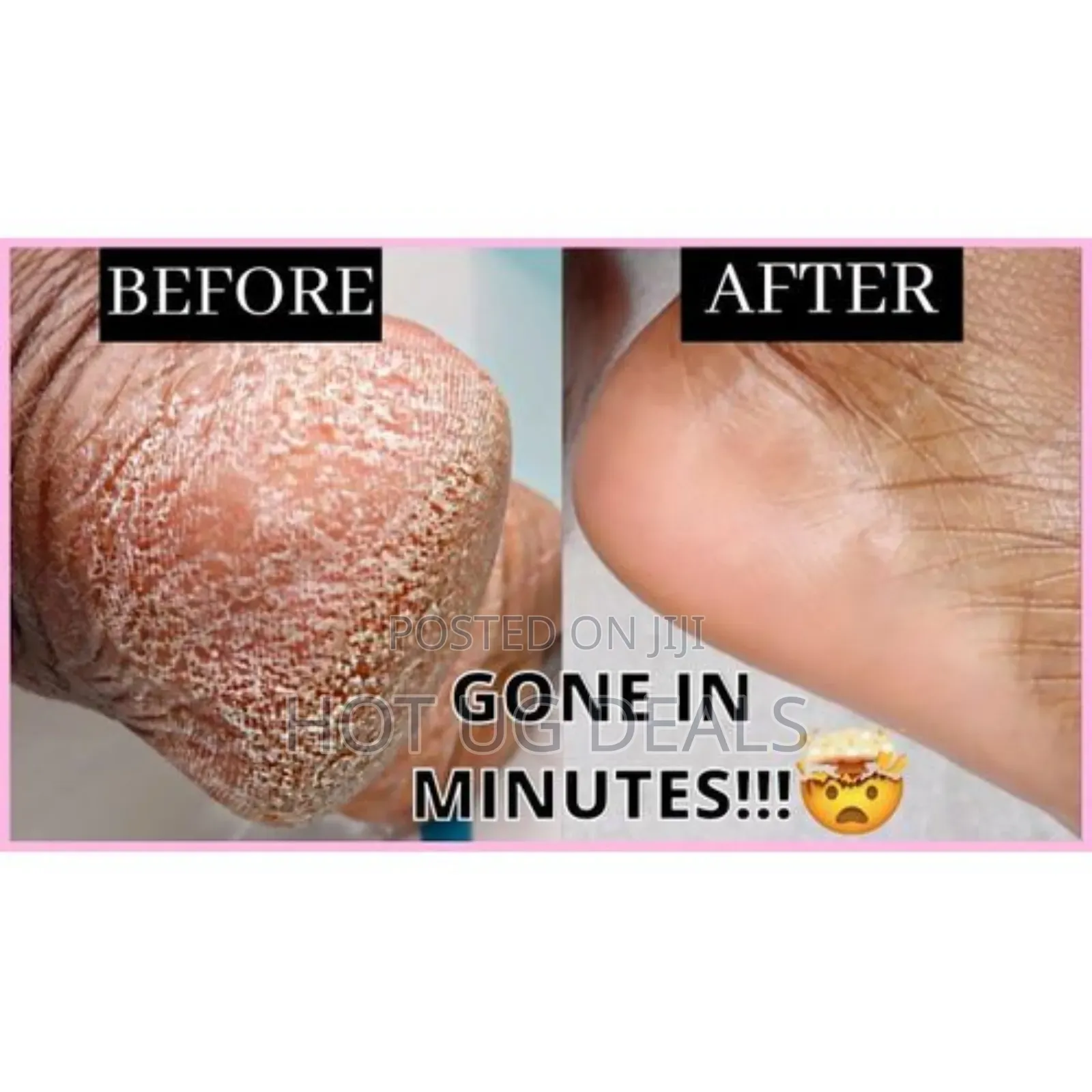 Rechargeable Feet Scrubber, Dead Feet Remover