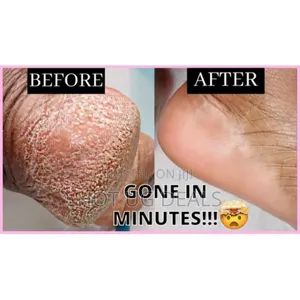 Rechargeable Feet Scrubber, Dead Feet Remover