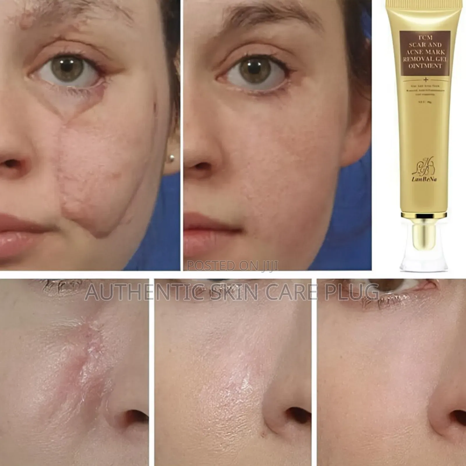 TCM Scar and Mark Removal Ointment Gel
