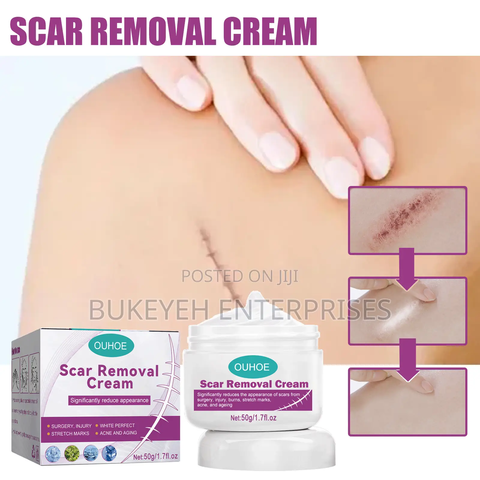 Hot Sale Scar Removing Cream and Repair All Kinds of Old Scars