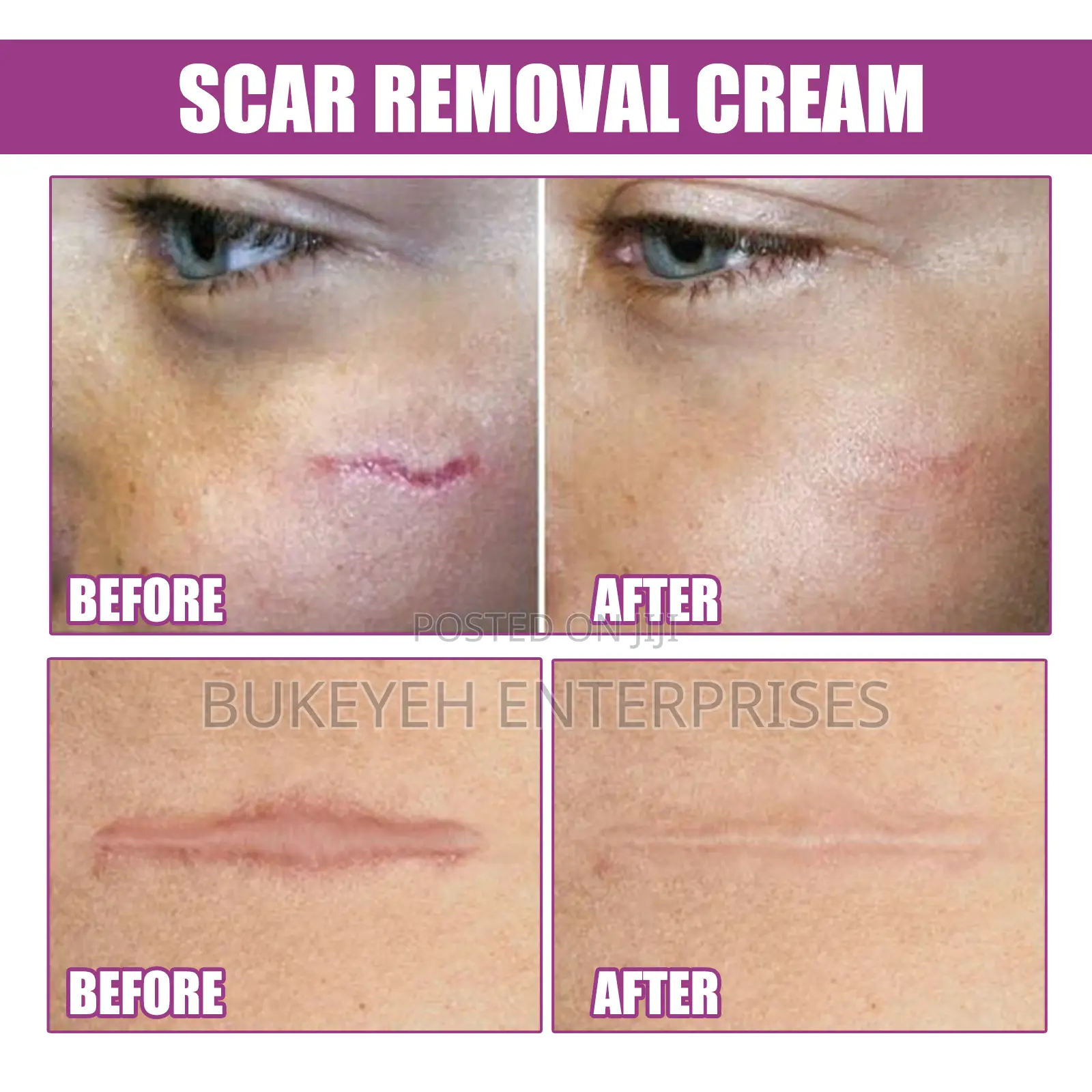 Hot Sale Scar Removing Cream and Repair All Kinds of Old Scars