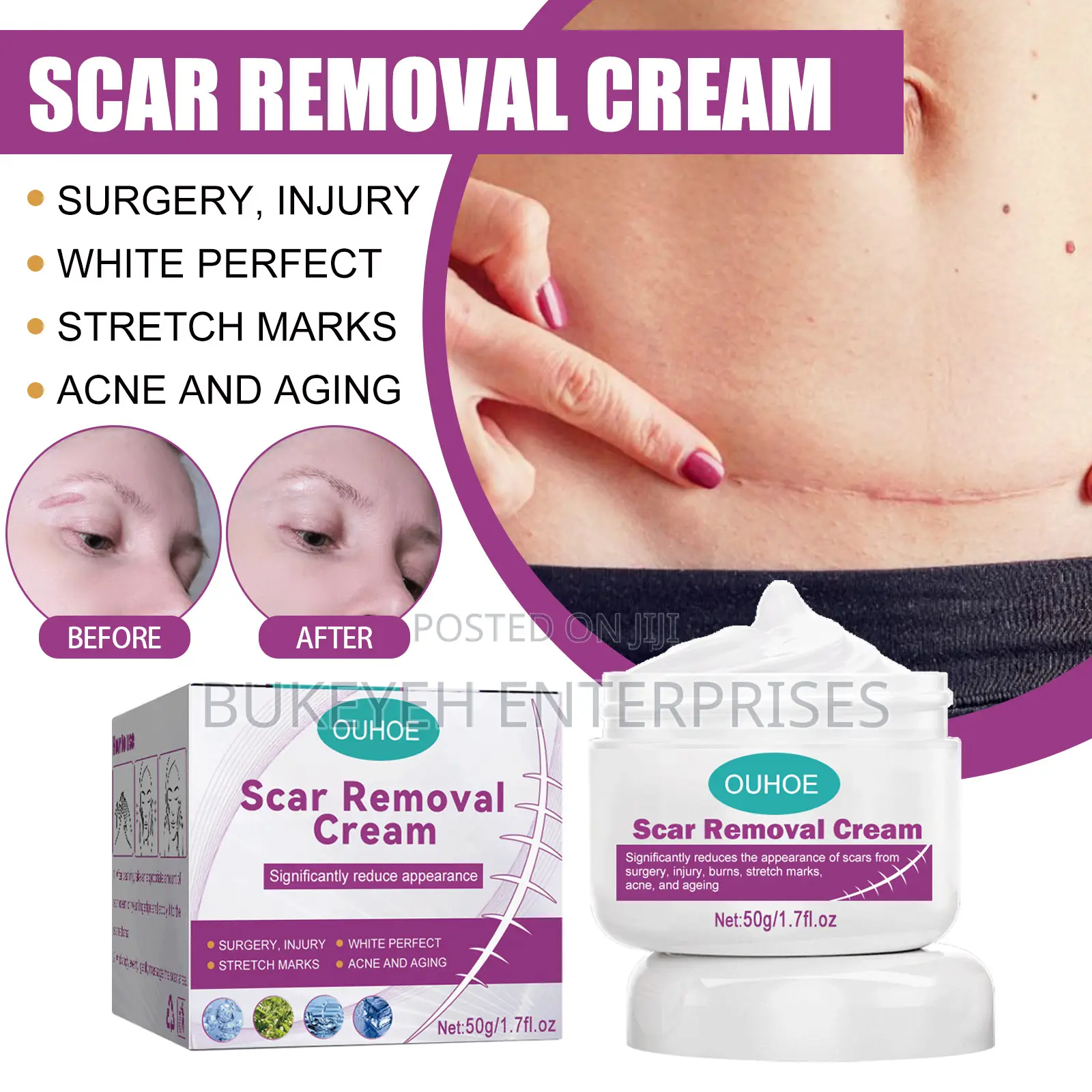 Hot Sale Scar Removing Cream and Repair All Kinds of Old Scars