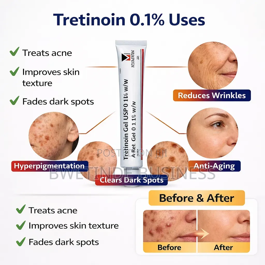 Tretinoin 0.1% for Wrinkles, Stretch Marks and Acne