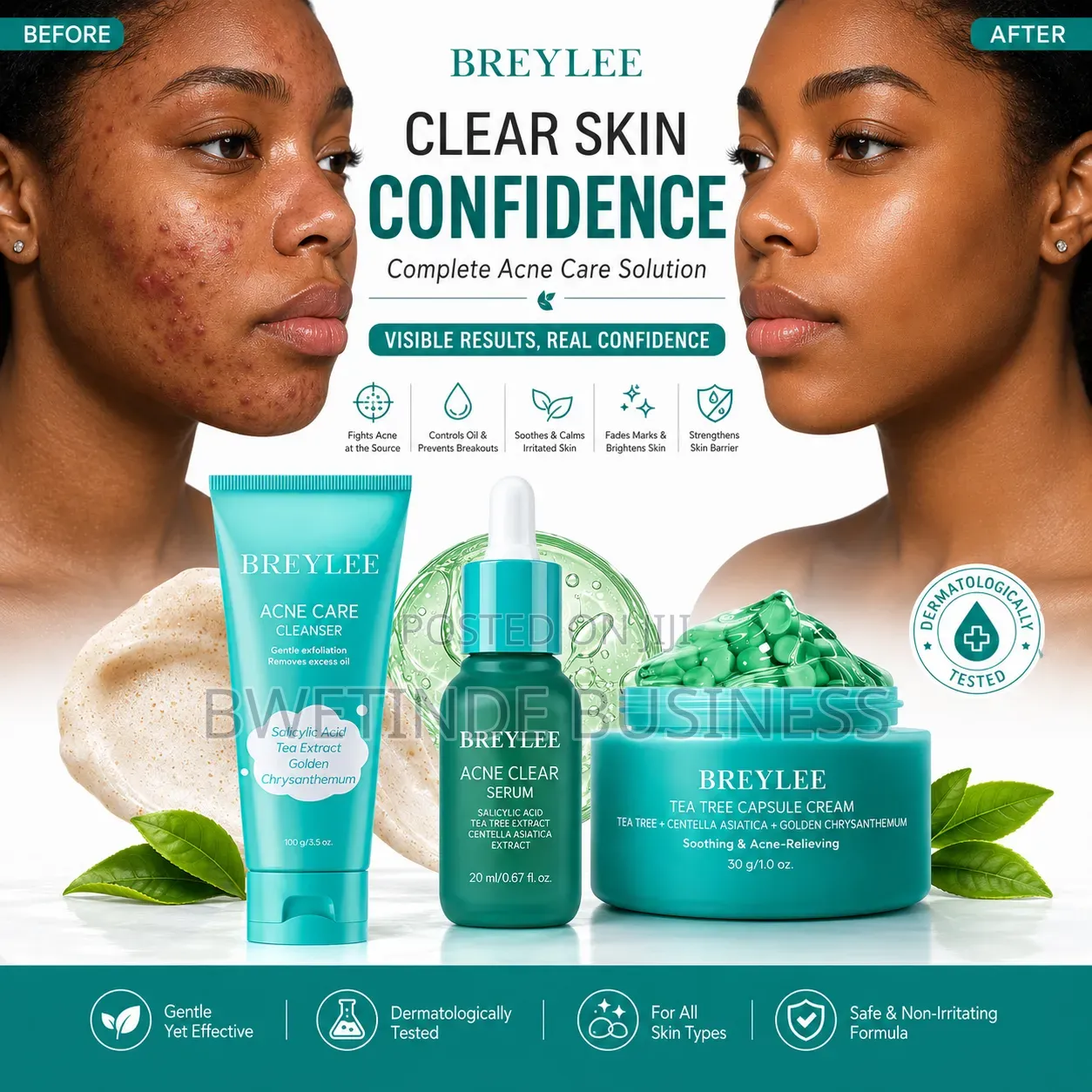 Breylee Acne Kit Salicylic Acid Cleanser, Acne Serum Tea Tree Cream