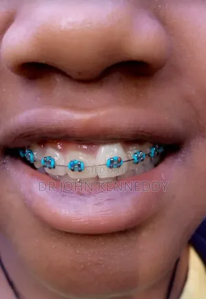 Braces ( Orthodontics)