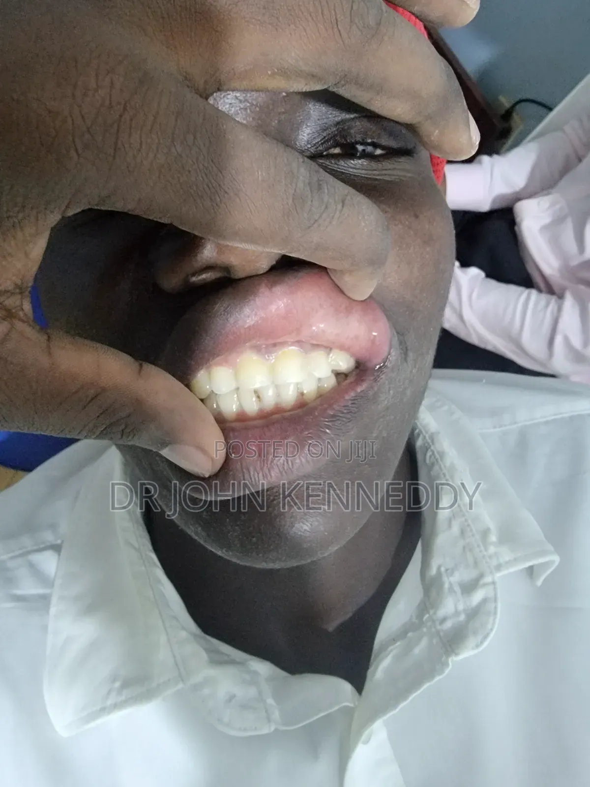 Tooth Restoration