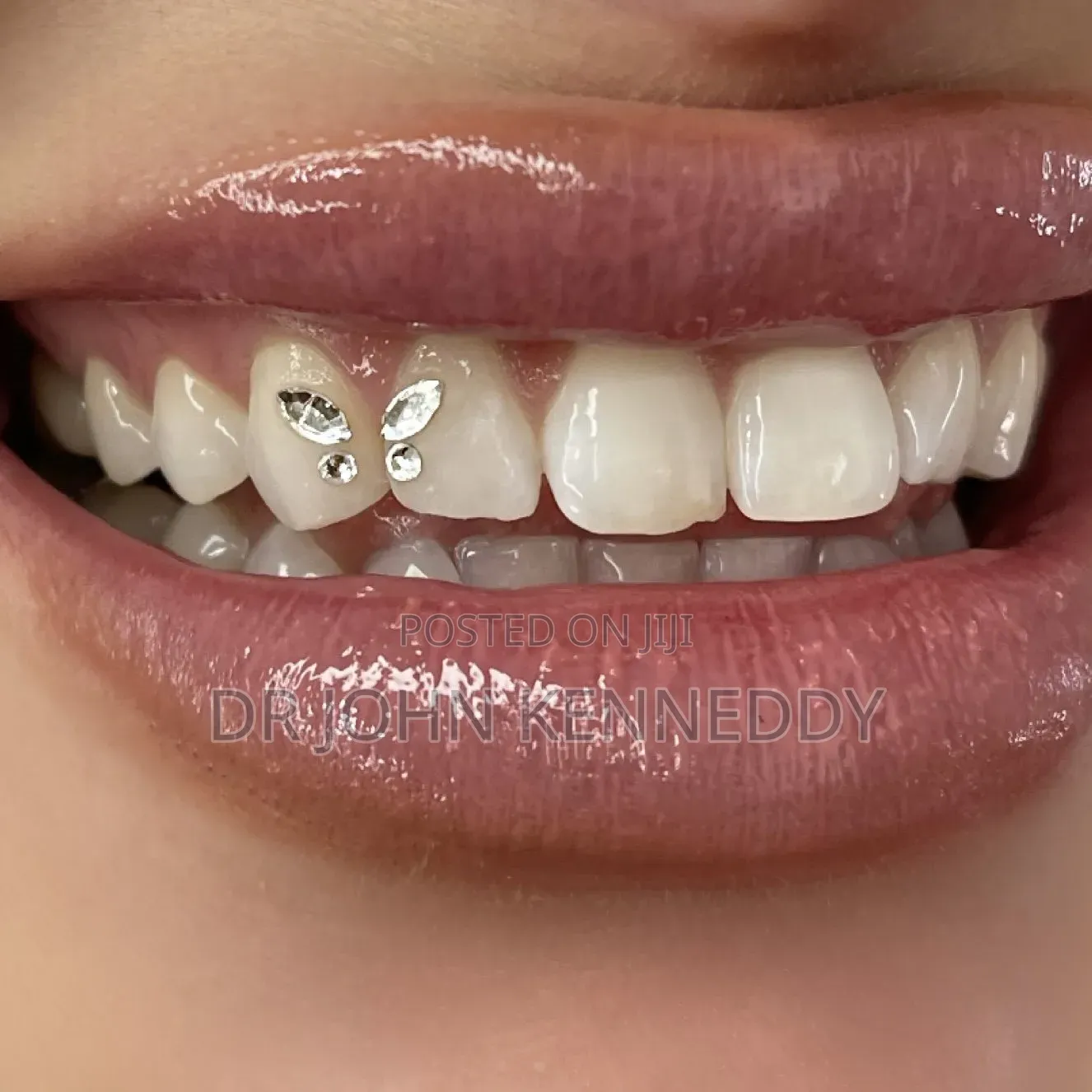 Tooth Gems Smile