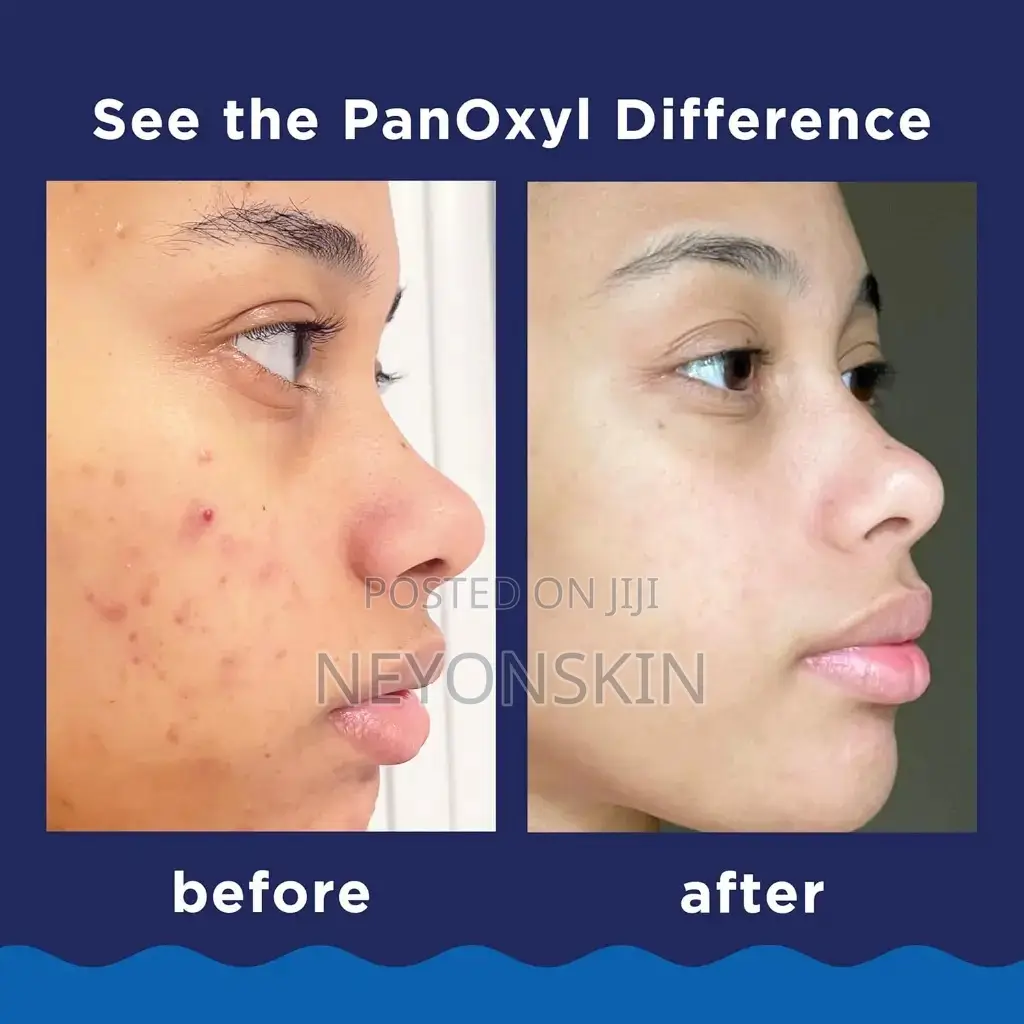 Panoxyl Acne Foaming Wash Benzoyl Peroxide 10%