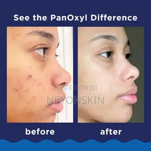 Panoxyl Acne Foaming Wash Benzoyl Peroxide 10%