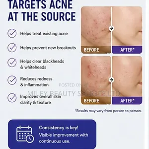 Epiduo Gel — Adapalene 0.1% + Benzoyl Peroxide 2.5%