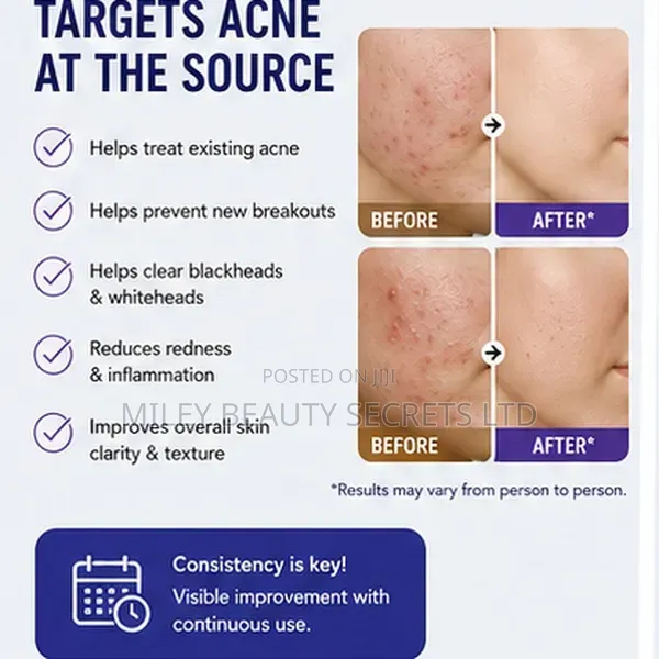 Epiduo Gel — Adapalene 0.1% + Benzoyl Peroxide 2.5%