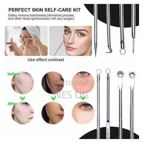 4Pcs Set Blackhead Removal Tool Kit