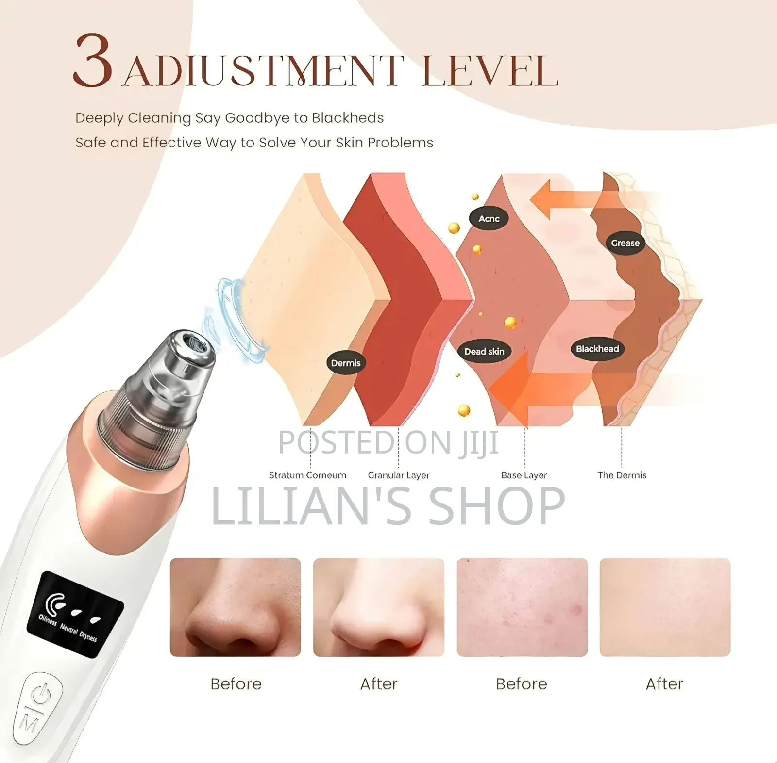Electric Blackhead Remover Vacuum