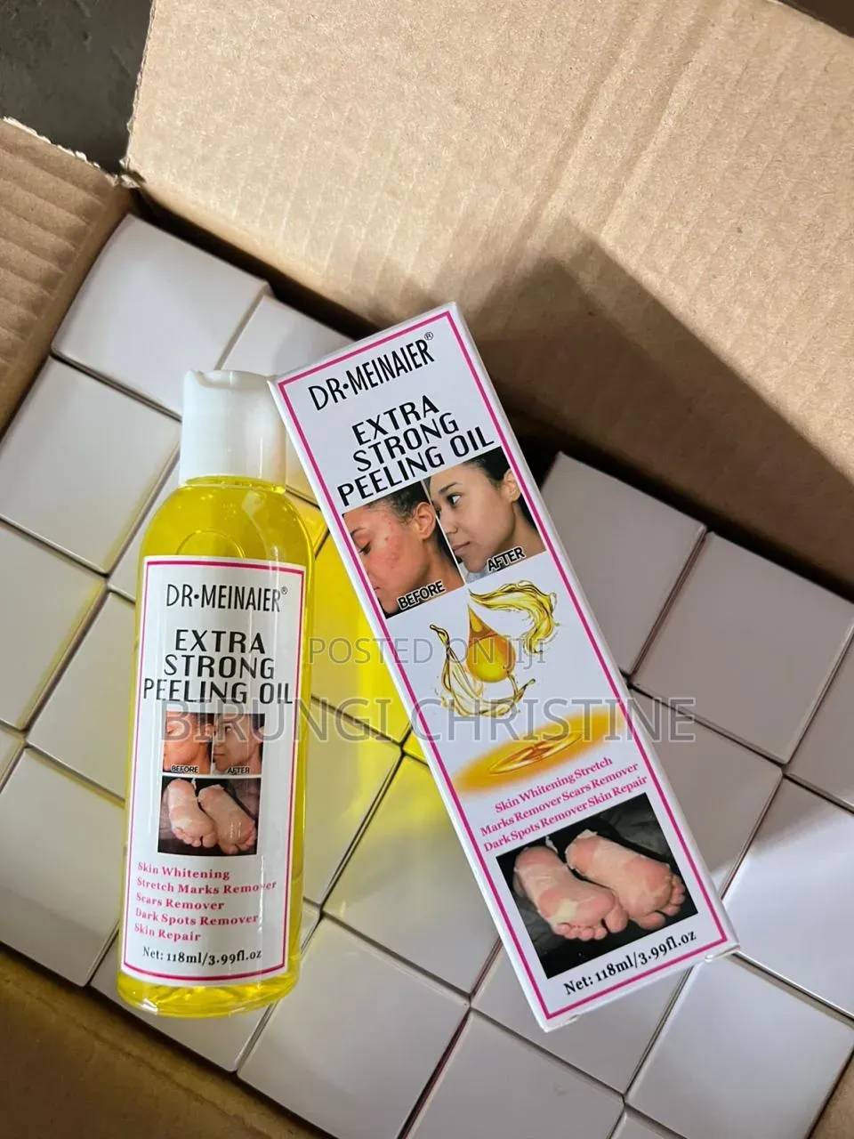 Stretch Marks Removal or Extra Peeling