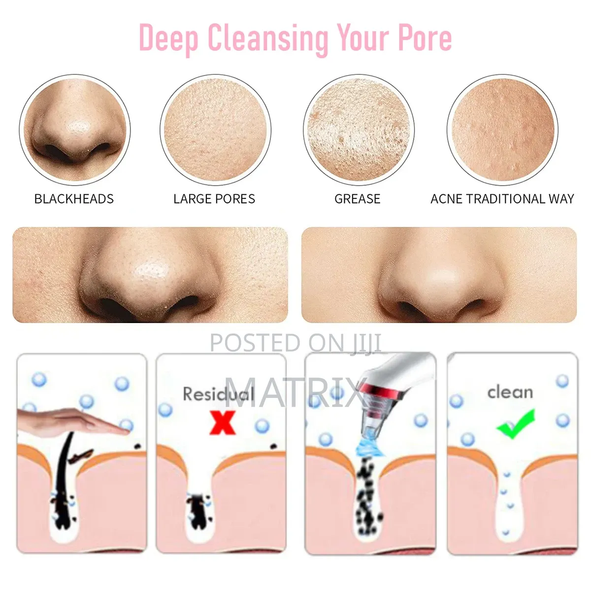 Blackhead Remover Vacuum Face Cleaner Pore Vacuum Suction White Heads