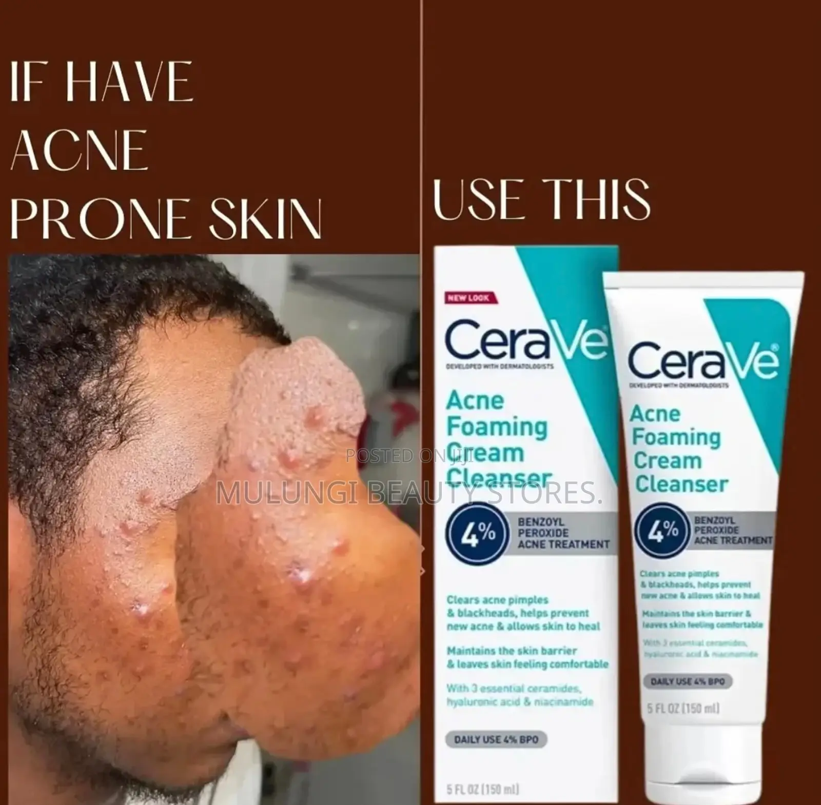 Cerave Acne Foaming Cream Cleanser With 4% Benzoyl Peroxide