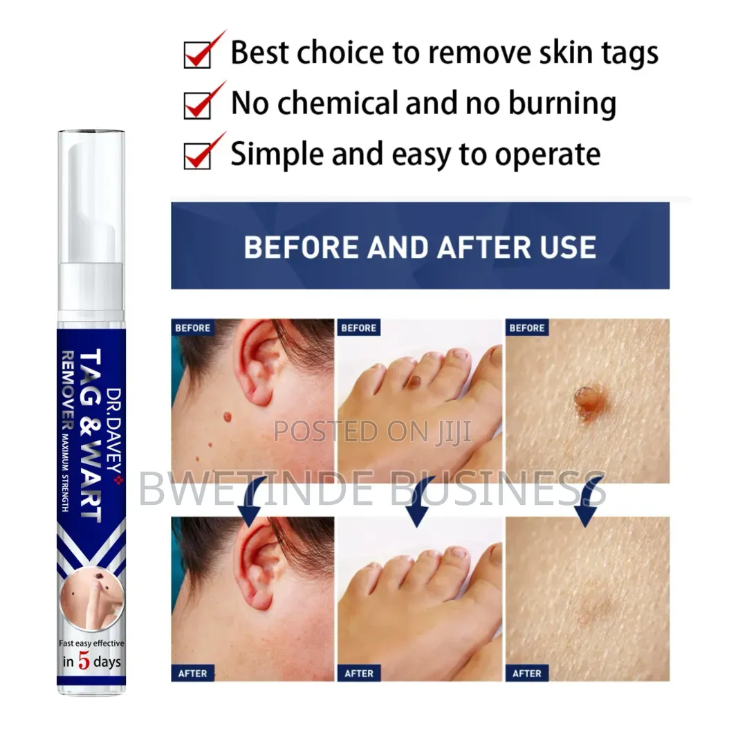 SKIN Tag Wart Remover – Fast Acting Skin Tag Treatment - 16ml
