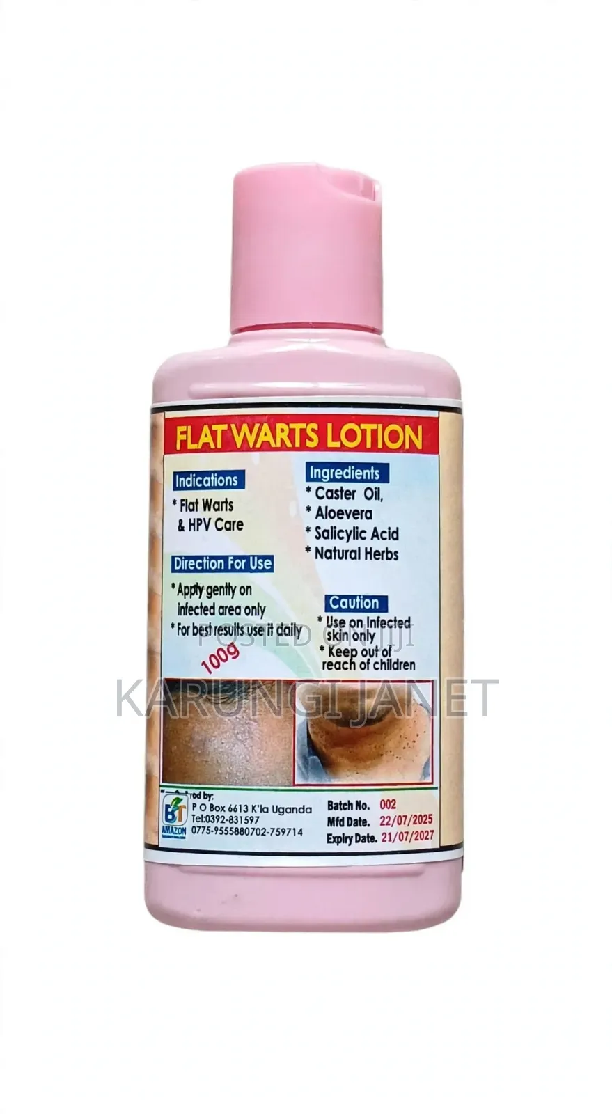 Flat Warts Lotion