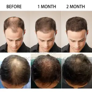 Anti Hair Loss Products Fast Grow