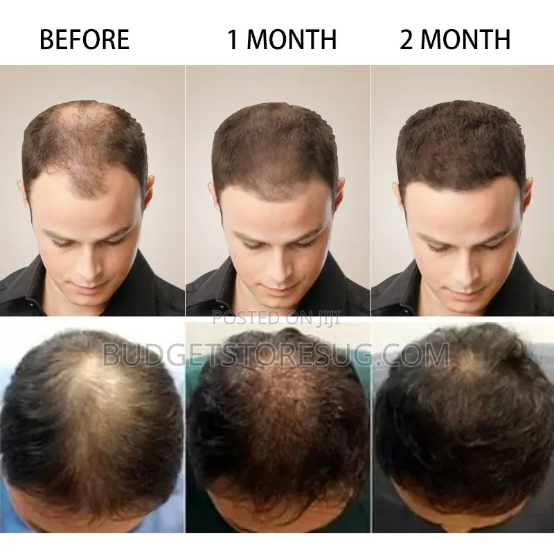 Anti Hair Loss Products Fast Grow