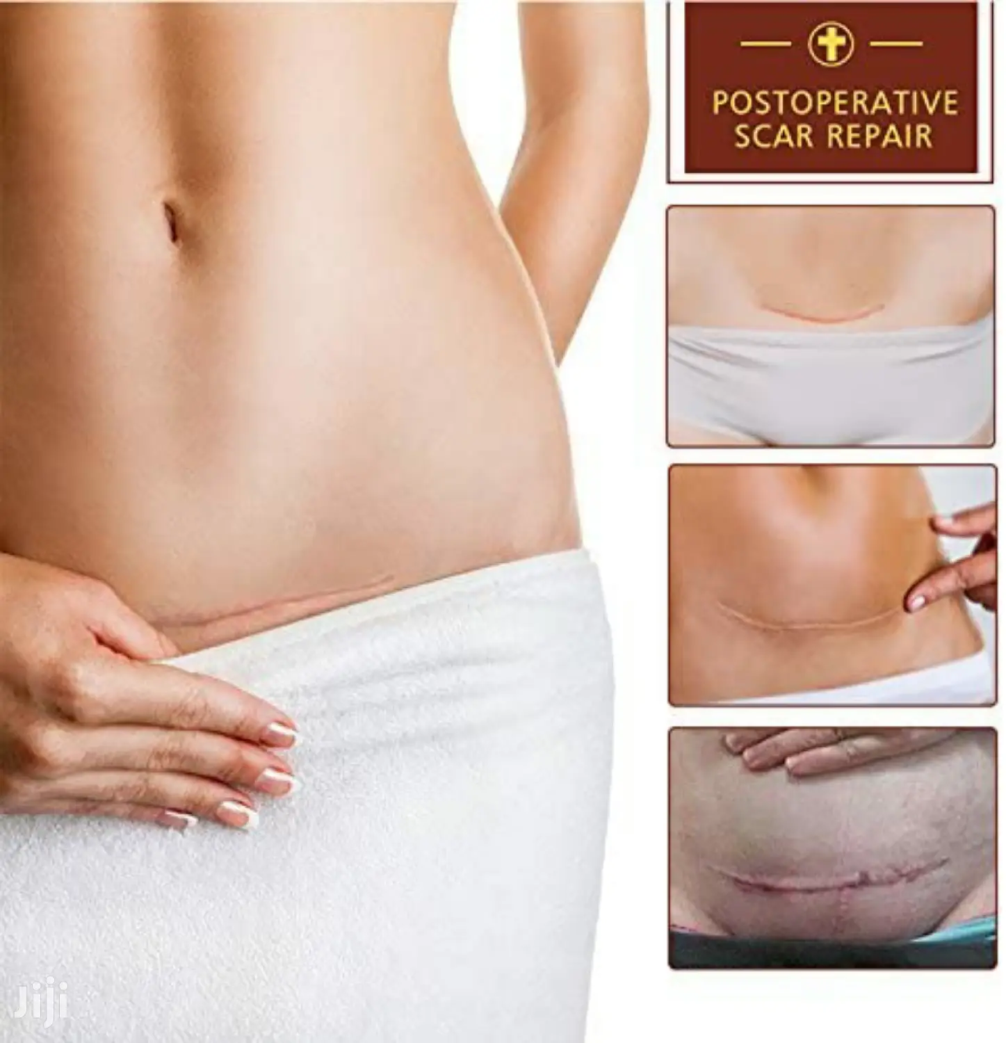 TCM Scar and Acne Marks Removal Cream, Green Veins Remover